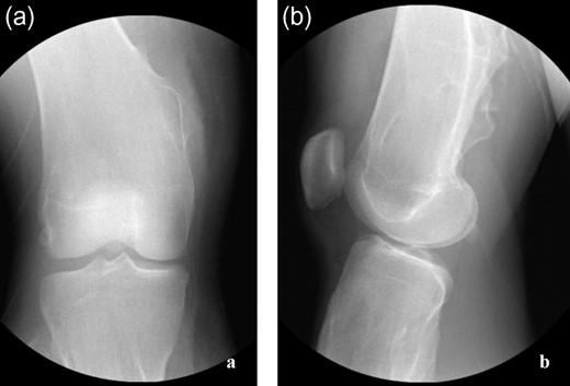 (a and b) Post-operative radiographs confirming adequate lesion excision about proximal tibia and distal femur.