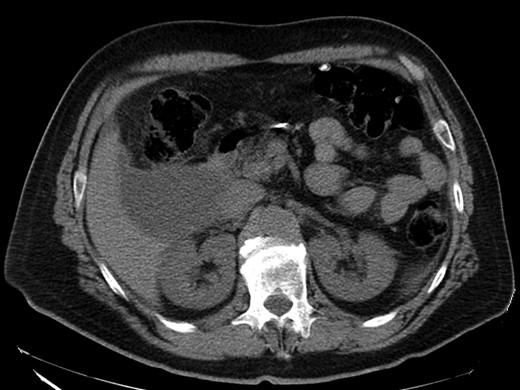 CT scan—axial view: hypodense lesion in segment VI of the liver.