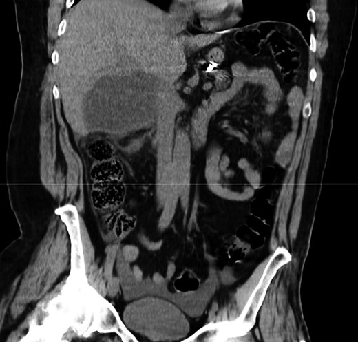 CT scan—coronal view: hypodense lesion in segment VI of the liver.