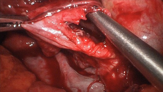 Exploratory laparoscopy showing the ruptured hepatic cyst.