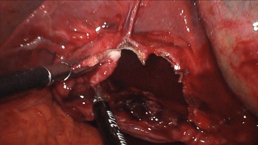Laparoscopic deroofing of the cyst using vessel-sealing device.