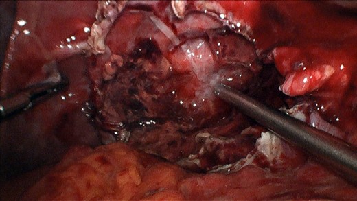 Final view after laparoscopic deroofing.