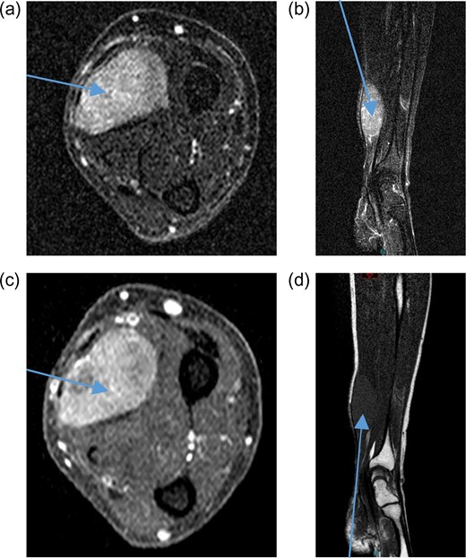 Pre-treatment contrast MRI of forearm showing large soft-tissue mas lesion involving the flexor aspect of right forearm (a) axial T2, (b) coronal T2, (c) axial T1 and (d) coronal T1.