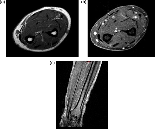 Post-treatment contrast MRI of the forearm showing curative resection and no evidence of recurrence in the flexor compartment (a) sagittal T1, (b) sagittal T2 and (c) coronal T1.