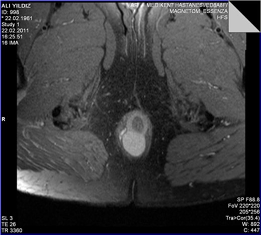 The leiomyoma originating from the internal anal sphincter growing far from the lumen stretching and pushing away the external anal sphincter.