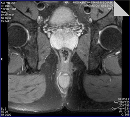 The perinal fistula passing intersphincterically upwards in close relation to the leiomyoma without invasion.