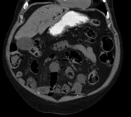 Pneumatosis intestinalis in jejunal and ileal loops, with hepatic venous gas evident.