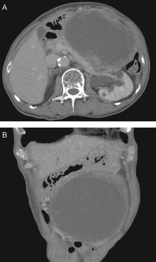 Image of abdominal CT Scan. CT scan revealed a tumor 180 mm in diameter in the region posterior to the gastric body. There was a large cyst in the tumor. Horizontal (A) and coronal (B) sections of the tumor are shown.