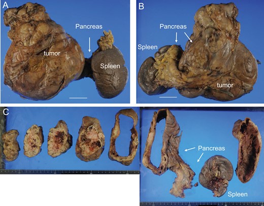 Macroscopic findings of the tumor. Anterior (A) and posterior (B) views of the resected tumor, pancreas, and spleen are shown. Cut sections of the tumor are also shown (C) (Bar = 5 cm). The tumor was resected, along with the pancreas and spleen.
