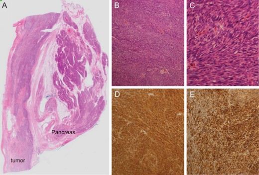 Microscopic findings of the tumor. Loupe image of the tumor and pancreas (A), low-power view (B), high-power view (C) and expression of CD117 (c-kit) (D) and CD34 (E) are shown (B and C, ×10 and ×40 in the objective lens; D and E, ×20 in the objective lens).