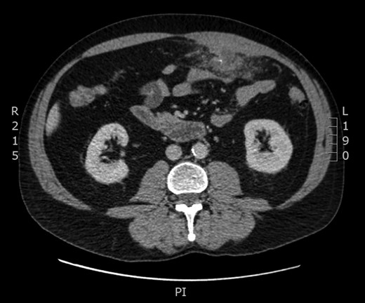 Computated tomography findings with axial image showing inflammatory changes involving the wall of the transverse colon left to the midline with associated abscess. Central opacification consistent with foreign body.