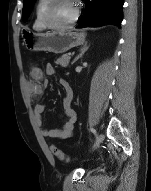 Sagittal image of anterior abdominal collection with central enhancement representing foreign body.