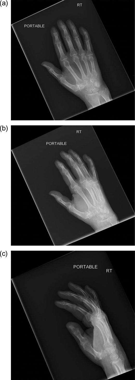 (a) AP image of the wrist showing a destructive lesion within the carpus. (b) Oblique image of the wrist showing a destructive lesion within the carpus. (c) Lateral view of the wrist showing a destructive lesion within the scaphoid. Note the near dissolution of the distal scaphoid and scalloping of the distal radius articular surface.
