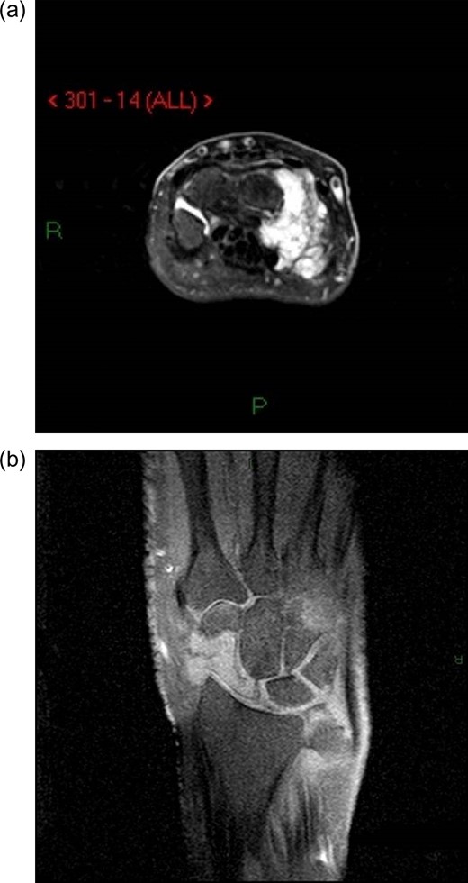 (a) Axillary MRI of the wrist. (b) Coronal MRI of the wrist.