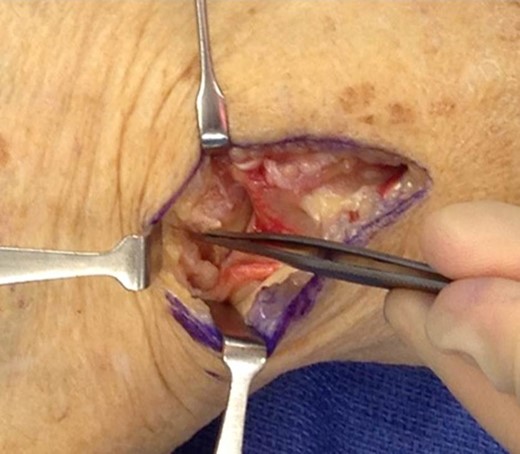 Gelatinous lesion emanating from the scaphoid and cavernous defect in the scaphoid.