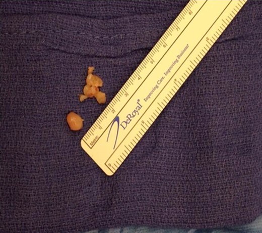 Tumor excised from scaphoid.