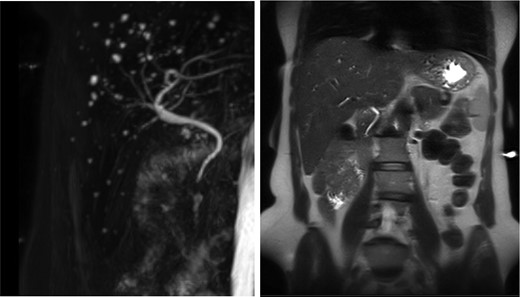 Absence of the gallbladder and the cystic canal with the presence of multiple liver cysts.