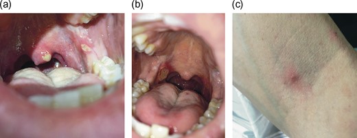 (a and b) Numerous painful ulcers of the oral cavity overlying the uvula, retromolar trigone and soft palate. (c) Papular skin lesions suggesting positive pathergy.