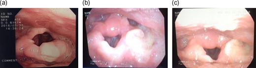 Flexible laryngoscopy demonstrated general oedema and distortion of the supraglottis. (a) An initial ulcerative lesion on the epiglottis. (b and c) Ulceration on the left aryepiglottic fold extending laterally into the left pyriform sinus. There is oedematous swelling of the arytenoids, but the vocal folds were found to be normal. There is subsequent scarring of the epiglottis following healing of the initial epiglottic ulcer.