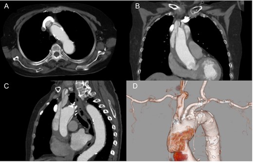 Preoperative computed tomography findings. Axial (A), coronal (B) and sagittal view (C). 3D computed tomography angiography (D). The brachiocephalic artery was occluded by the false lumen.