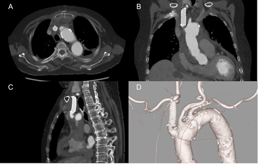 Postoperative computed tomography showing patent carotid stent and no residual dissection. Axial (A), coronal (B) and sagittal view (C). 3D computed tomography angiography (D).