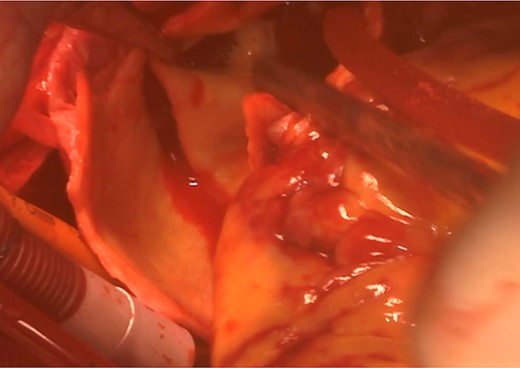 Inserted open brachiocephalic artery stent.
