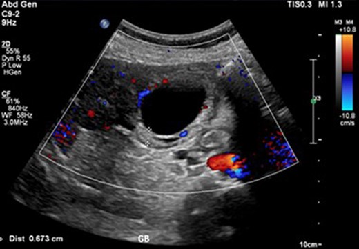 Ultrasound image of cholecystitis demonstrating thickened gallbladder wall.