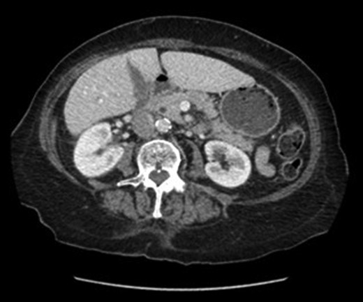 CT image of pancreatitis with peripancreatic fat stranding.