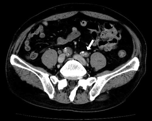 Preoperative abdominal CT showed bilateral iliac arterial stenosis to 5 mm diameter with calcification (the arrows). Internal iliac arteries had been obstructed bilaterally.