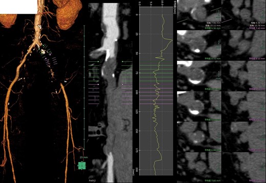 Postoperative 3D-contrast enhanced CT revealed the complete obstruction of left common iliac artery (CIA). The sagittal section through the left iliac artery and the graph of left CIA’s internal diameter showed significant stenosis.