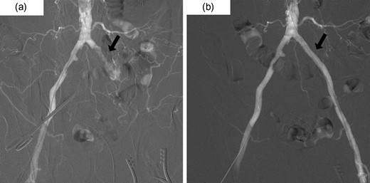 (a) Pre-intervention aortography demonstrating occlusion of the left CIA and the development of collateral circulation in left pelvic cavity. (b) Post-intervention aortography showing improvement of occlusion by a percutaneous transluminal angioplasty (PTA) with stent.