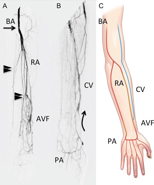(a) The early phase of pre operative angiography shows that brachial artery stenosis (arrow), multiple arterial occlusions in the forearm (black arrowheads). (b) The late phase of pre operative angiography demonstrates steal syndrome: palmar arch to arteriovenous fistula blood flow (arrows). (c) Schematic presentation of ischemic upper extremity. BA, brachial artery; RA, radial artery; CV, cephalic vein; PA, palmar arch; AVF, arteriovenous fistula.