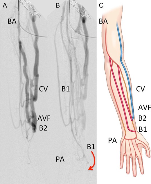 (a) The early phase of post-operative angiography shows enough blood flow in arteriovenous fistula. (b) The late phase of post-operative angiography demonstrates arterioarterio distal bypass to re-vascularize digital circulation. Arrow indicates the direction of blood circulation. (c) Schematic presentation of distal dual bypass BA, brachial artery; B1, the first bypass (arterioarterio bypass); B2, the second bypass (arteriovenous bypass); CV, cephalic vein; PA, palmar arch; AVF, arteriovenous fistula.