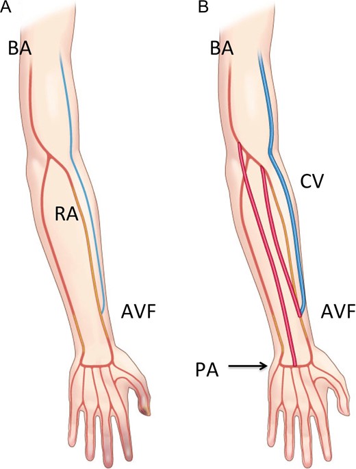 Schematic presentation of distal dual bypass in upper extremity to establish re-vascularization in hands and arteriovenous fistula. BA, brachial artery; RA, radial artery; CV, cephalic vein; PA, palmar arch; AVF, arteriovenous fistula.