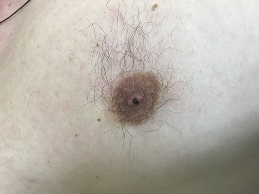 Single duct nipple discharge in a man.