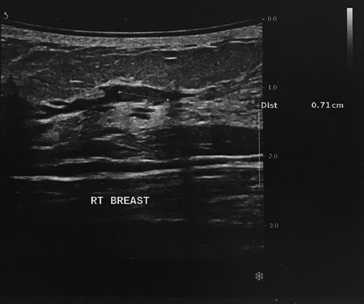 Ultrasonographic appearance of the papilloma within a duct.