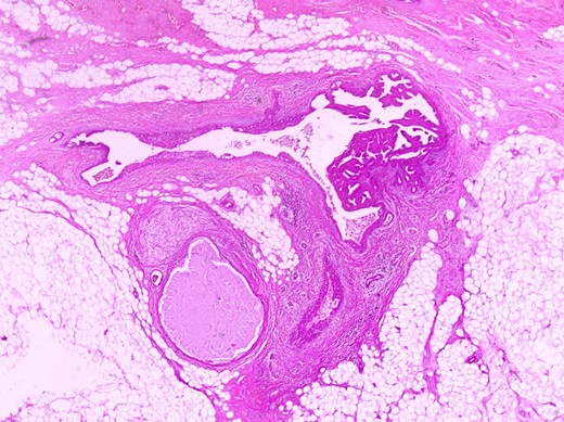 Partially dilated duct with papillary projections within its lumen (in the right side of it) (H+Ex400).