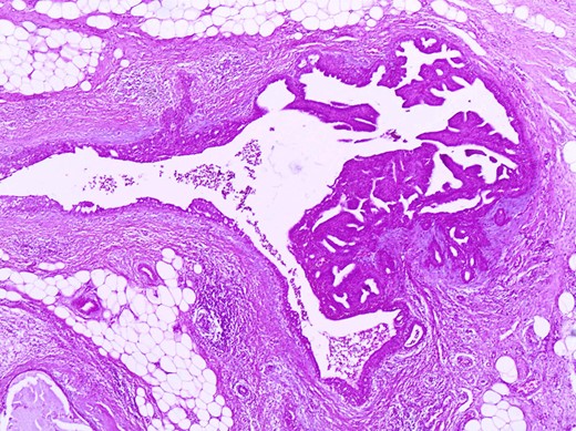 The same duct with the papillary projections. The wall is fibrotic and there are also foci of usual type of epithelial hyperplasia (H+E×100).