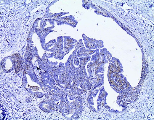 Immunohistochemistry with CK14 demonstrates the myoepithelial cells in the papillary structures (CK14×200).