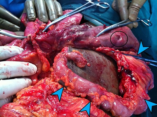 The Blue arrows outline the duplicated bowel loop. Black arrow shows the normal bowel. The black circle shows one of the perforations in the duplicated loop.
