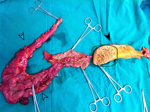 The Blue arrows outline the duplicated bowel loop. The Black arrow shows the normal bowel. The Green square outlines a thickened patch of mucosa at the site of communication of duplicated bowel with the ileum.