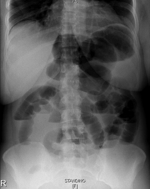 Erect abdominal X-ray showing proximal small bowel dilatation with multiple air fluid levels suggestive of bowel obstruction.