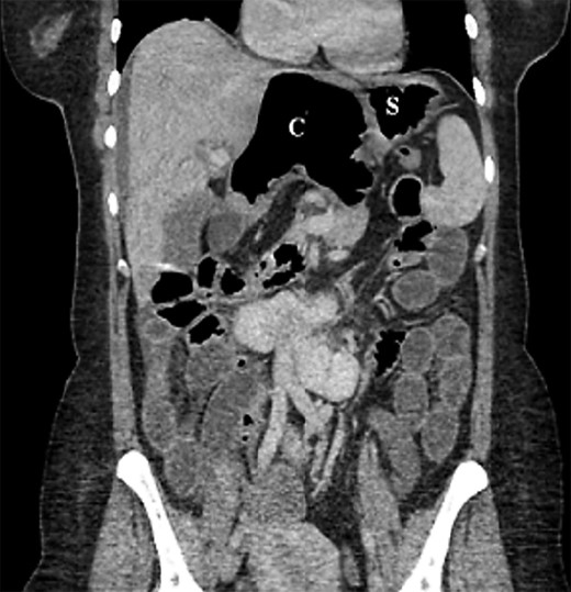 Coronal section of abdominal computed tomography scan showing the cecum (C) flipped superiorly and positioned anterior to the transverse colon and herniated into foramen of Winslow. The cecum occupies the lesser sac, and it is distended with gas, causing a mass effect on the stomach (S) and hepatic root with associated intrahepatic bile duct dilatation. This is associated with proximal small bowel dilatation and collapsed large bowel loops distally.