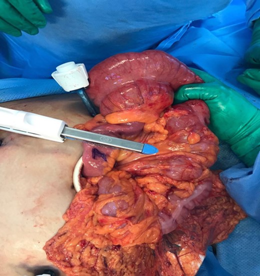 The bowel is retrieved through an Alexis retractor for better evaluation of devascularization.
