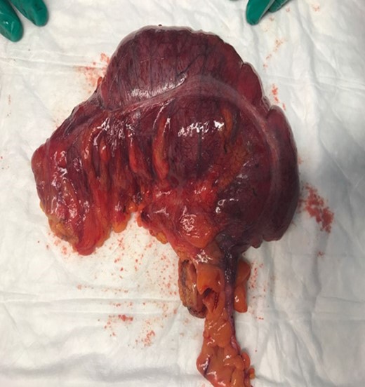 Gross appearance of the resected ileocecal with a dusky coloration.