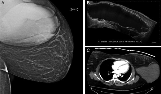 Results of pre-operative (A) mammography (B) ultrasound and (C) computed tomography (CT).