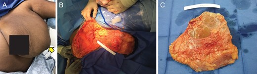 (A) Pre-operative photograph of the left breast mass. (B) Intraoperative resection of mass. (C) Gross pathology of resected mass.