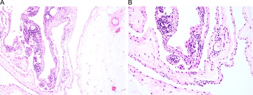 Surgical specimens were collected and stained with H&E. Representative images are shown at (A) low and (B) high magnification, which affirmed the diagnosis of cystic lymphangioma.
