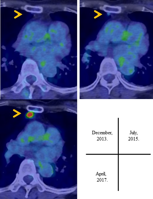 PET scan showed in the accumulation of FDG in the anterior mediastinal tumor in the follow-up period.