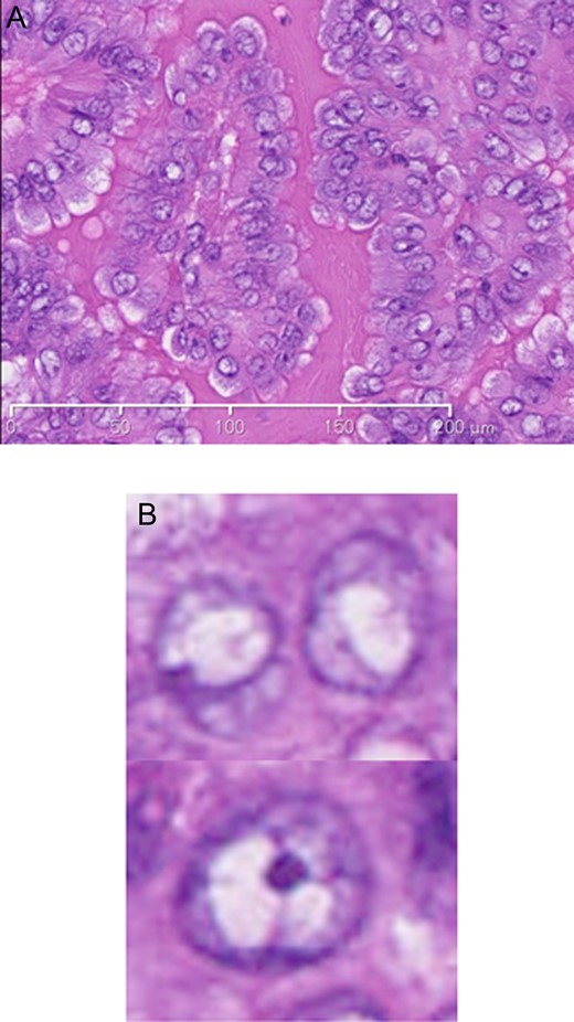 The pathological findings of specimens from the tumor: (A) A microscopic examination of the resected tumor revealed papillary carcinoma (B) and tumor cells with relatively ground glass nuclei and nuclear grooves (hematoxylin and eosin staining).